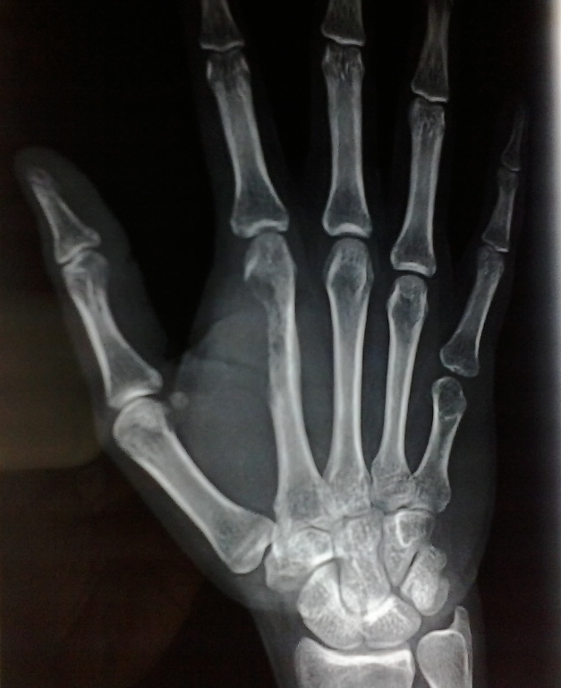Shows pre-operative x-ray of Giant cell tumor of tendon sheath involving second metacarpal bone